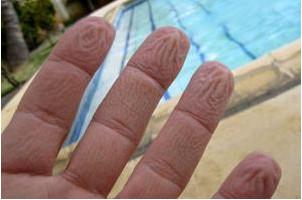 為什么手指泡在水里會(huì)起皺