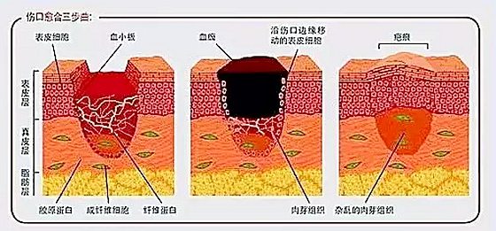 為什么傷口愈合時(shí)會(huì)感覺(jué)癢,傷口愈合特別癢怎么辦