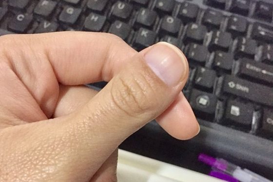 人的大拇指為什么只有兩節(jié),拇指怎么只有兩個(gè)關(guān)節(jié)