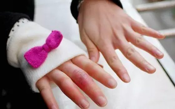 人為什么會生凍瘡,生凍瘡怎么辦