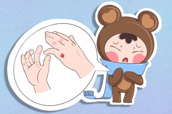 人為什么會生凍瘡,生凍瘡怎么辦